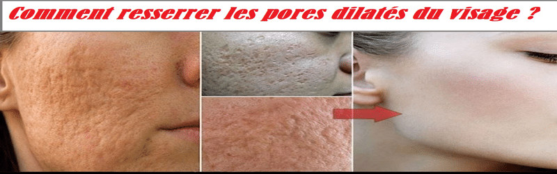 Comment resserrer les pores dilatés du visage ?