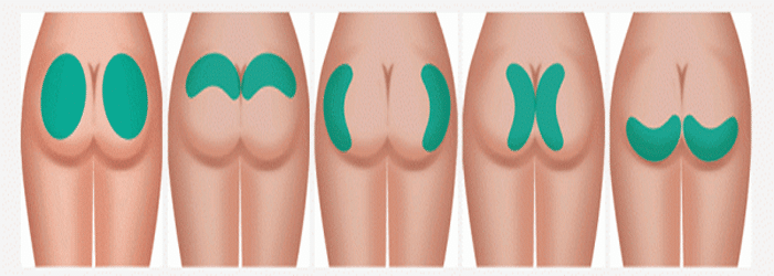 Méthode d'installation de l'implant