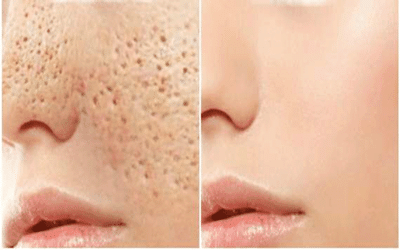 Comment refermer les pores naturellement