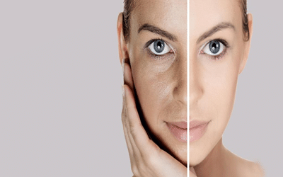 pore dilaté visage
