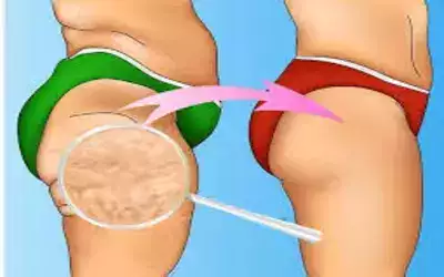 10 remèdes efficaces pour éliminer la cellulite naturellement